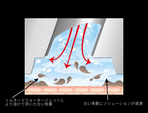 トルネードウォータージェットにより溶けて浮いた古い角質　古い角質にソリューションが浸透